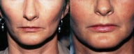 Lip Augmentation