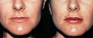 Lip Augmentation