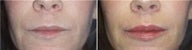 Juvederm for Lip Augmentation