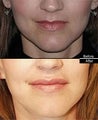 Lip Augmentation with Restylane
