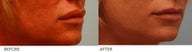 Lip Reduction
