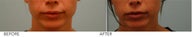 Upper Lip Reduction