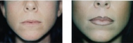 Lip Augmentation