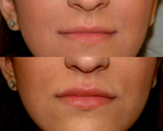 Lip Injection