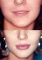 Lip Augmentatoin