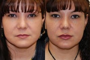 Lip Augmentation with Silikon-1000