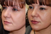 Lip Augmentation with Silikon-1000