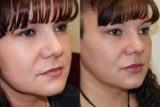Lip Augmentation with Silikon-1000