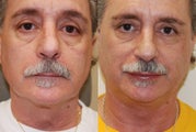 Lip Augmentation with Silikon-1000 for permanent results.