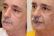 Lip Augmentation with Silikon-1000.