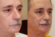 Lip Augmentation with Silikon-1000