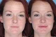 Juvederm Lip Augmentation