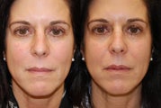 Lip Augmentation with Silikon-1000