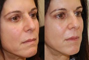 Lip Augmentation with Silikon-1000