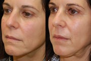Lip Augmentation with Silikon-1000