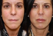 Lip Augmentation with Silikon-1000. 2 treatments.