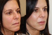 Lip Augmentation with Silikon-1000. 2 treatments.