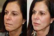 Lip Augmentation with Silikon-1000. 2 treatments.