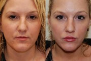 Lip Augmentation with Silikon-1000. 2 treatments.