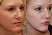 Lip Augmentation with Silikon-1000. 2 treatments.