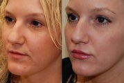 Lip Augmentation with Silikon-1000. 2 treatments.