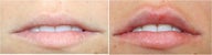 Lip Volume and Shaping
