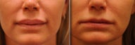 Upper and Lower Lip Reduction