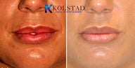 Juvederm Lip Augmentation