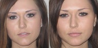 Non Surgical Lip Enhancement