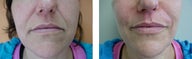 Juvederm