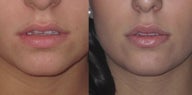 Non Surgical Lip Enhancement
