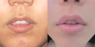 Non Surgical Lip Enhancement