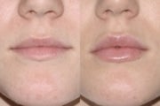 Lip Augmentation