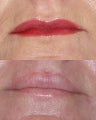 Lip Lift