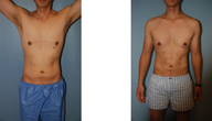 Liposculpture