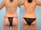 liposuction