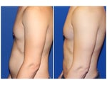 Liposculpture
