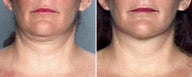Liposuction of the Neck