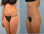 Liposuction