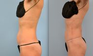 Liposuction