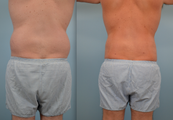 Liposuction