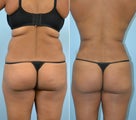Liposuction