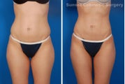 Liposuction
