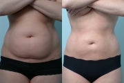 Liposculpture