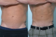 Liposculpture