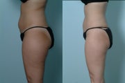Liposculpture