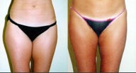 Liposuction of the inner & outer thighs