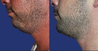 lipo submental