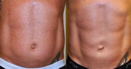 Liposculpture