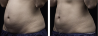 liposonix